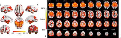 Changes of Regional Neural Activity Homogeneity in Preclinical Alzheimer’s Disease: Compensation and Dysfunction